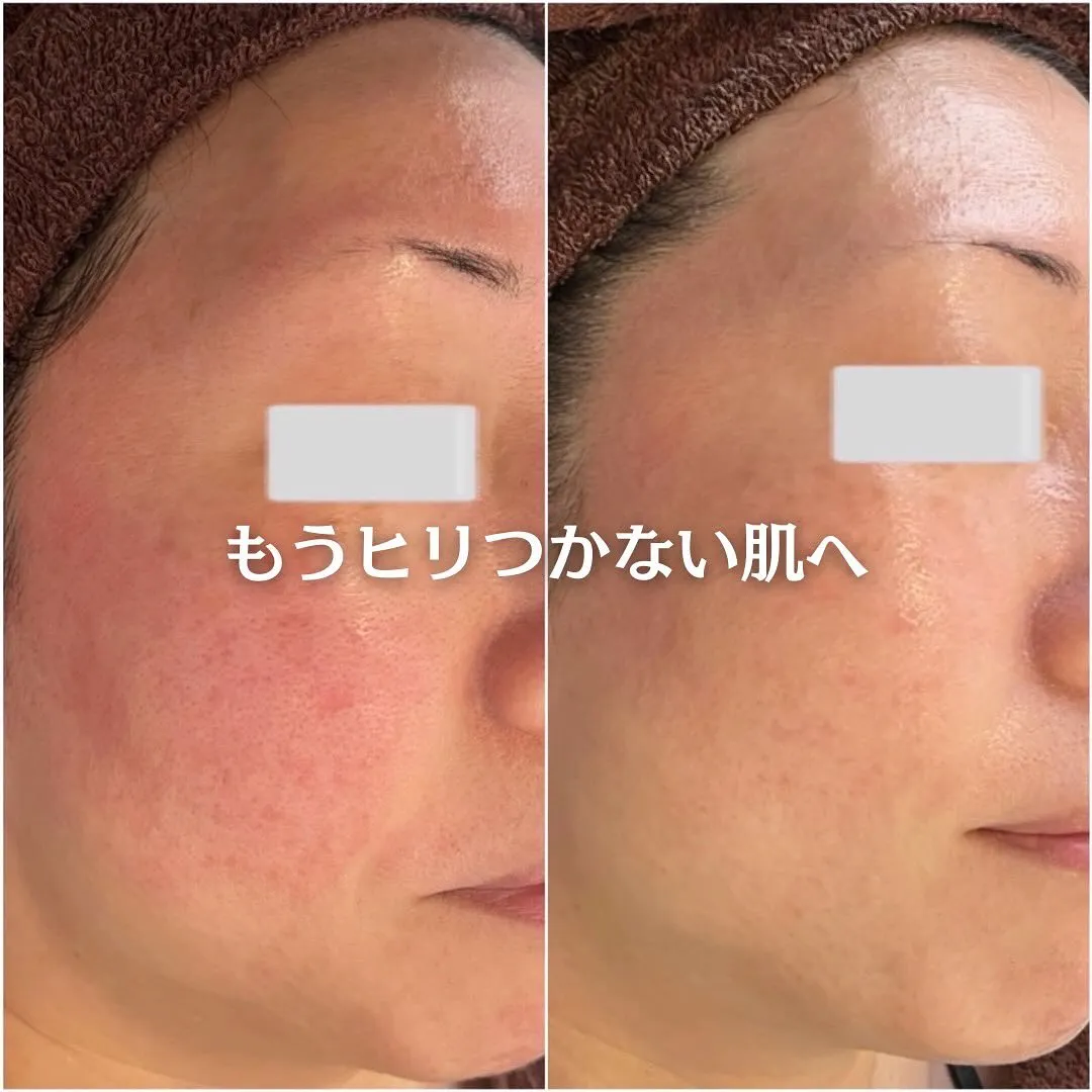 太田市にある頑固なニキビ専門店です✨️