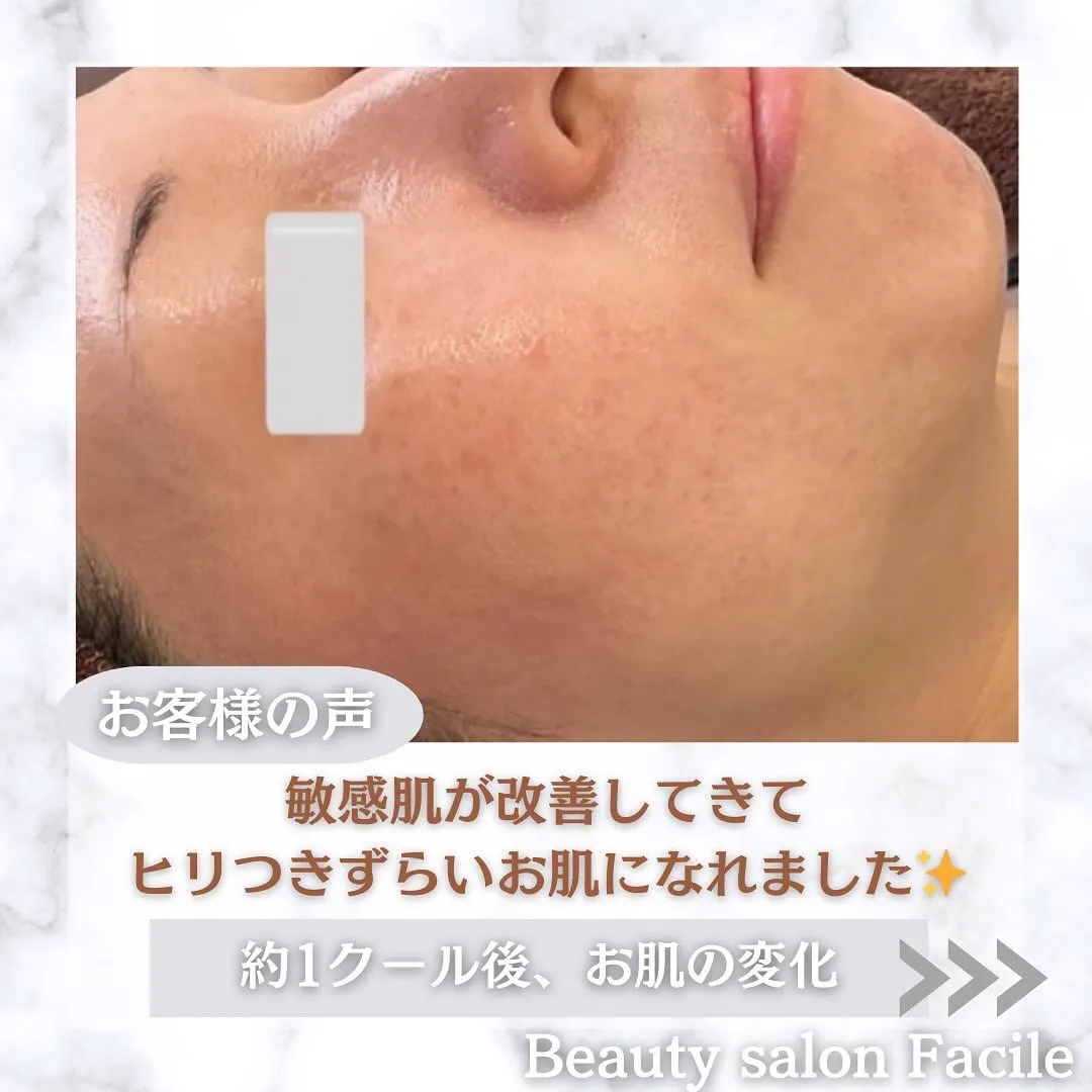 太田市にある頑固なニキビ専門店です✨️