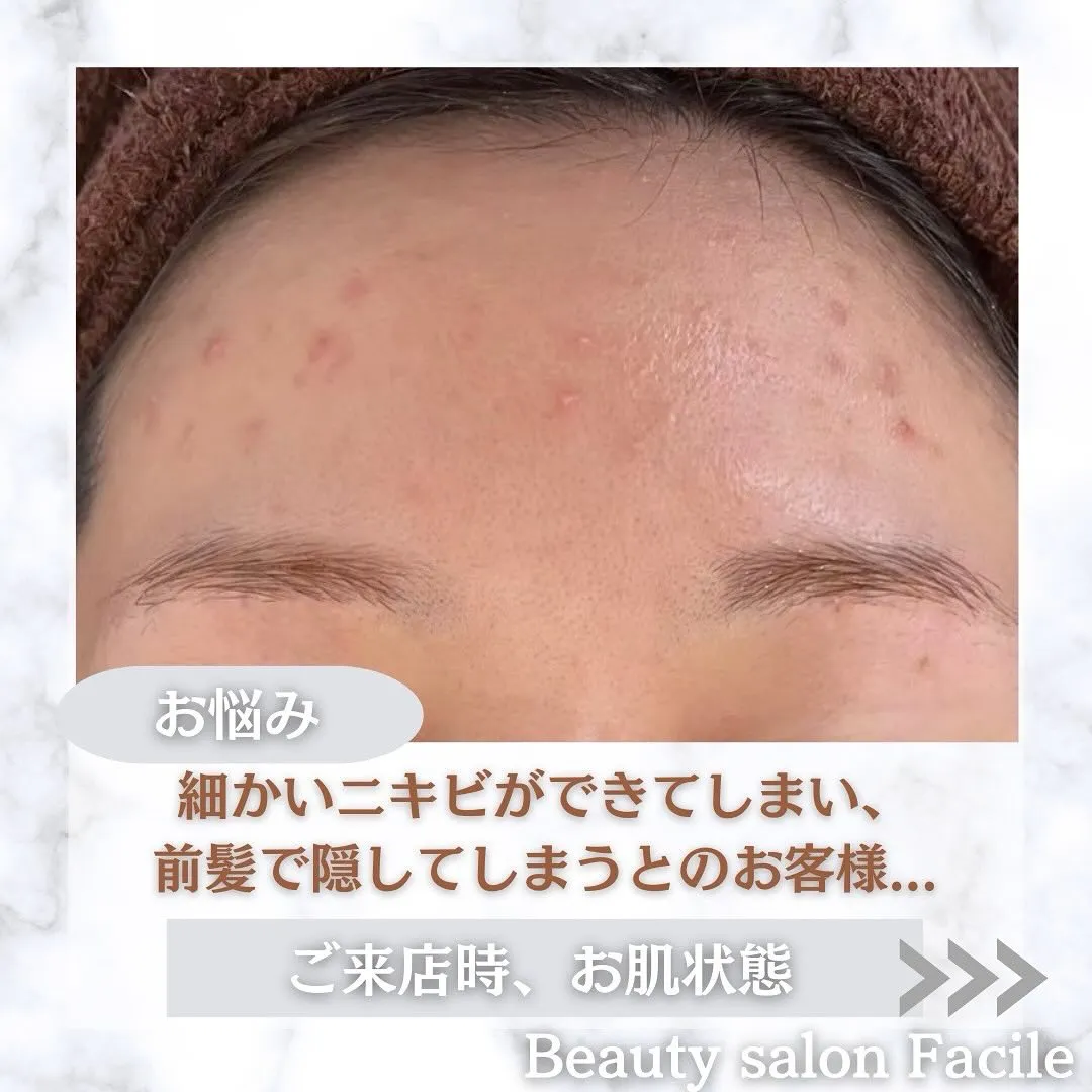 太田市にある頑固なニキビ専門店です✨️