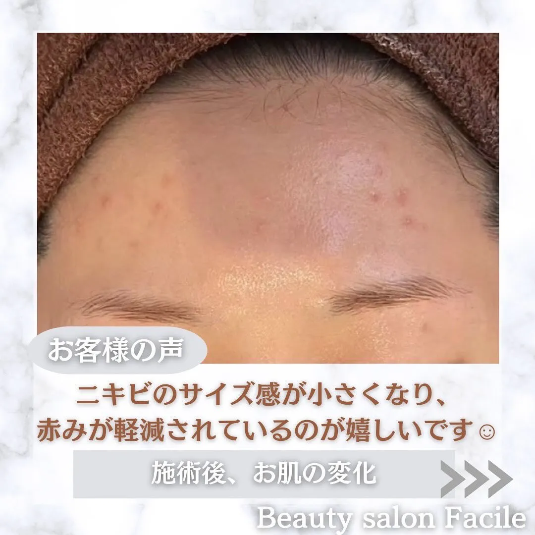 太田市にある頑固なニキビ専門店です✨️