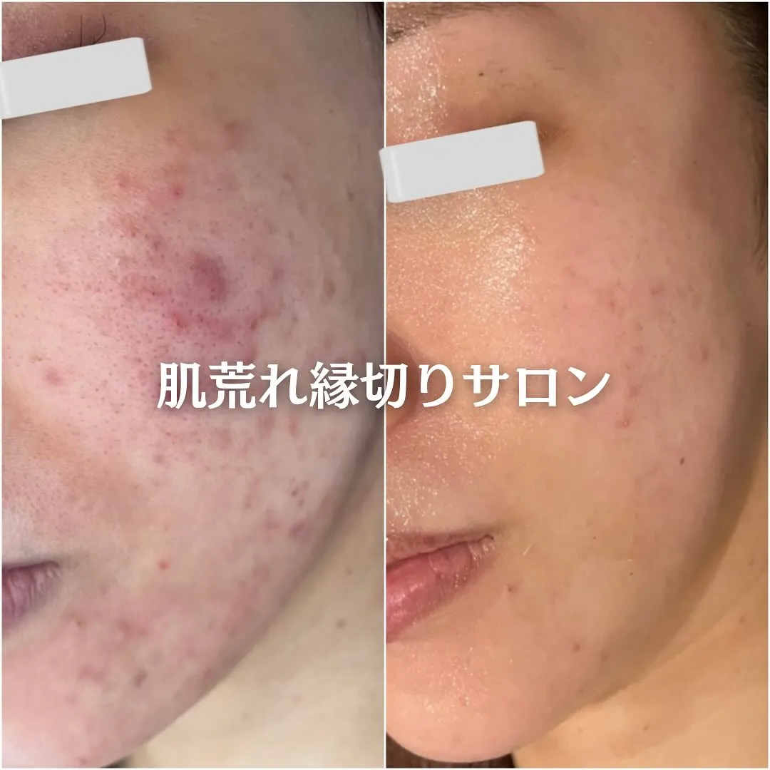 太田市にある頑固なニキビ専門店です✨️