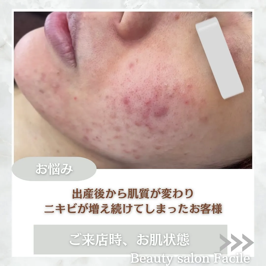 太田市にある頑固なニキビ専門店です✨️