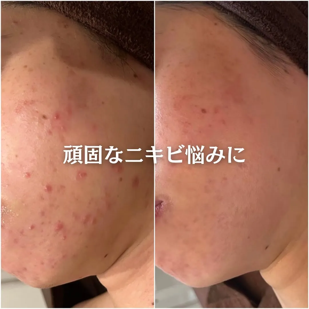 太田市にある頑固なニキビ専門店です✨️
