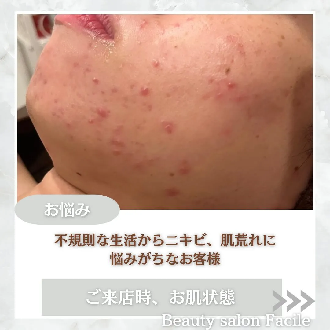 太田市にある頑固なニキビ専門店です✨️