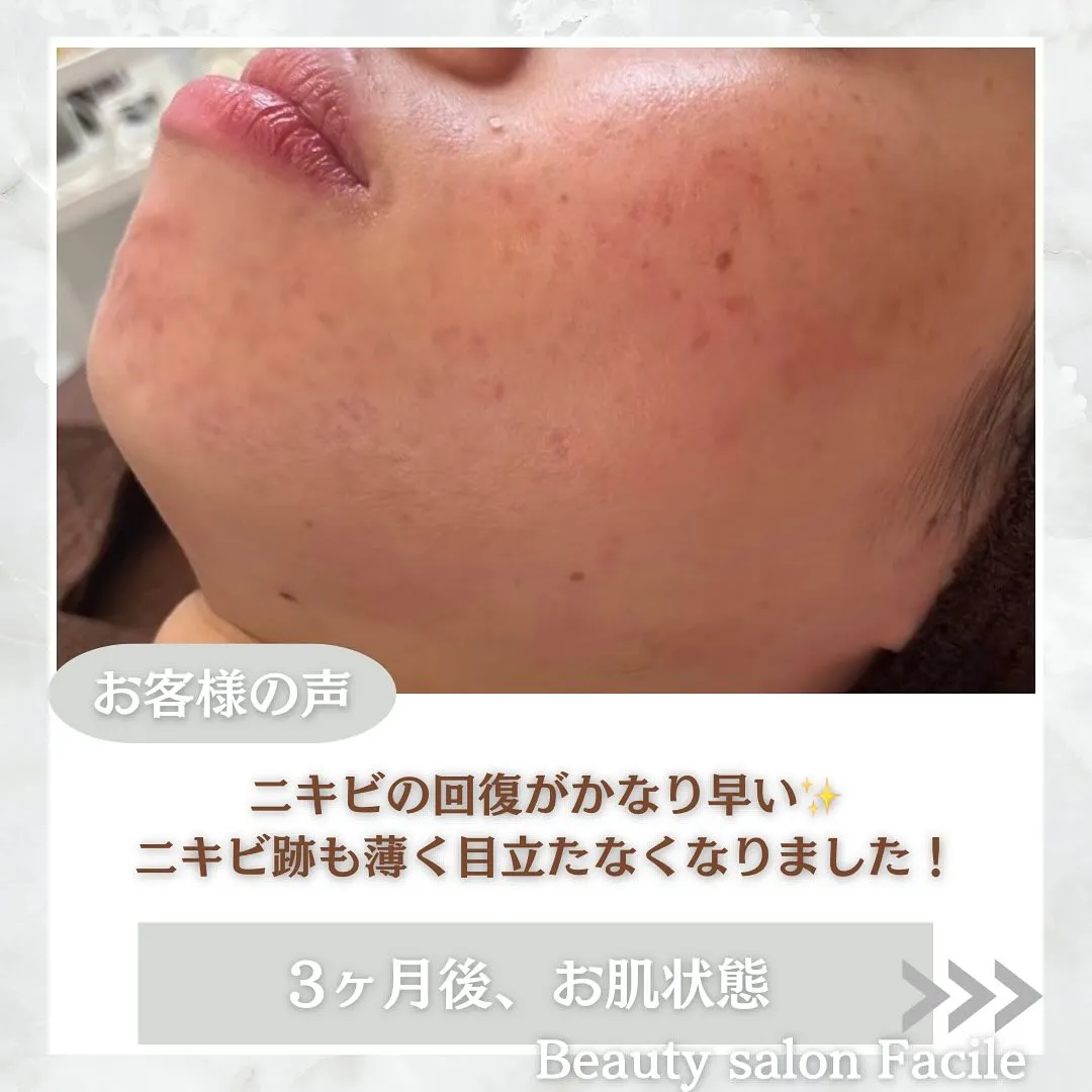 太田市にある頑固なニキビ専門店です✨️