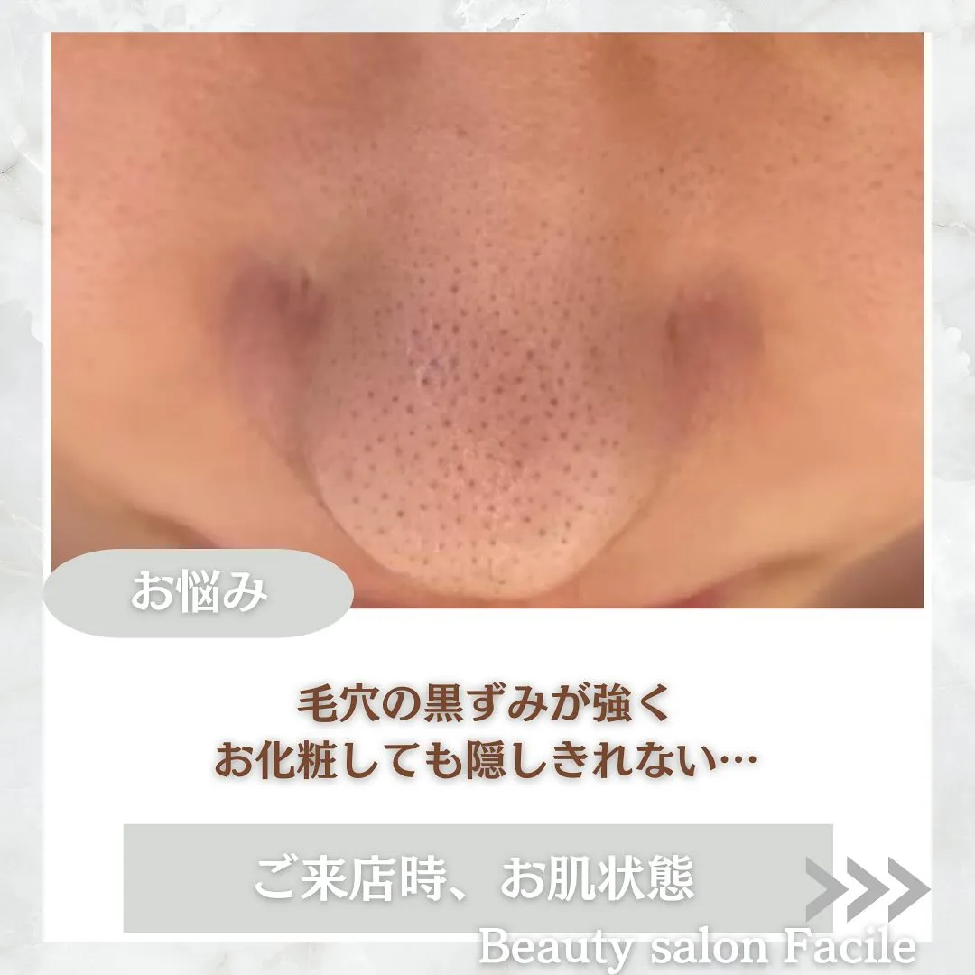 太田市にある頑固なニキビ専門店です✨️