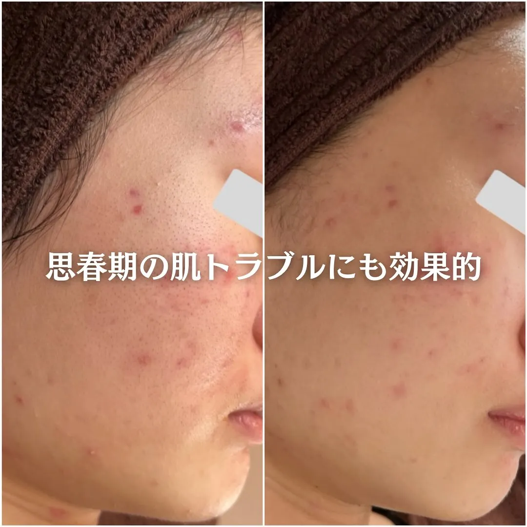 太田市にある頑固なニキビ専門店です✨️