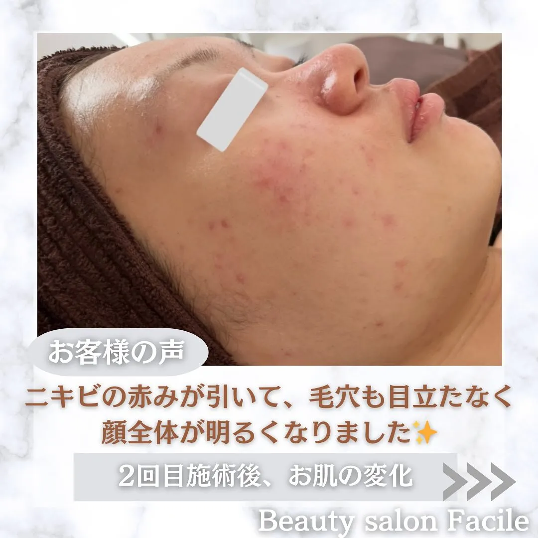 太田市にある頑固なニキビ専門店です✨️