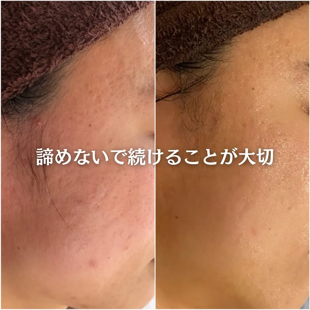 太田市にある頑固なニキビ専門店です✨️