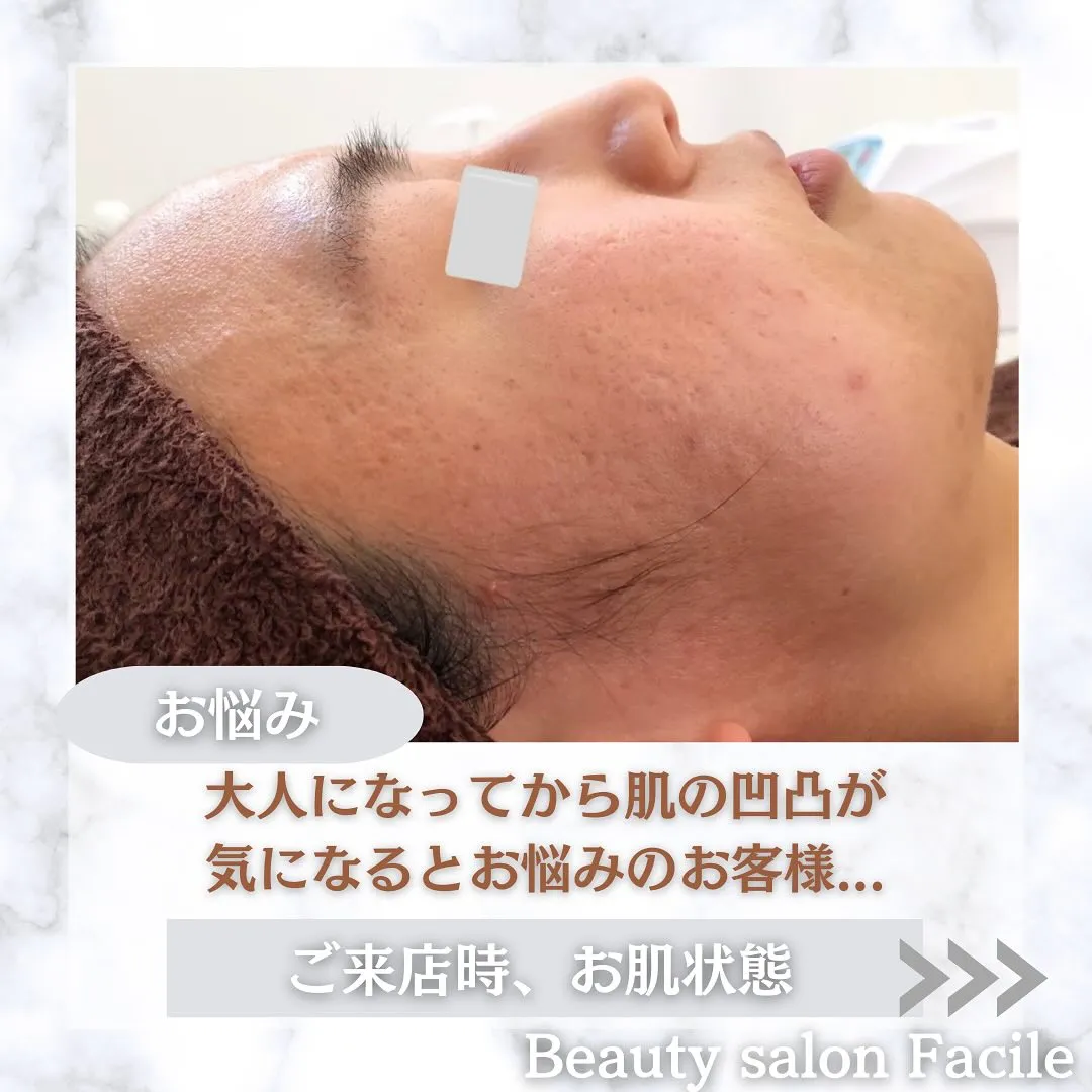 太田市にある頑固なニキビ専門店です✨️