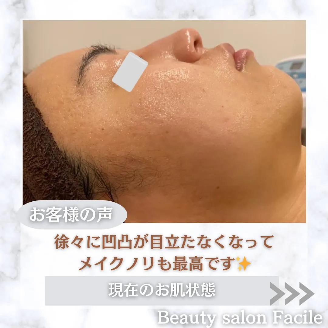 太田市にある頑固なニキビ専門店です✨️