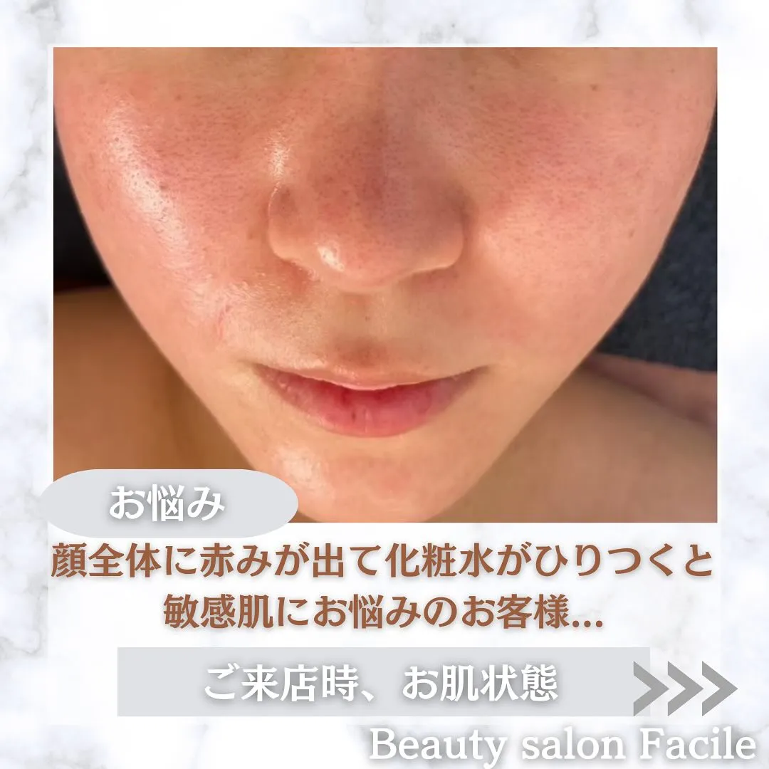 太田市にある頑固なニキビ専門店です✨️