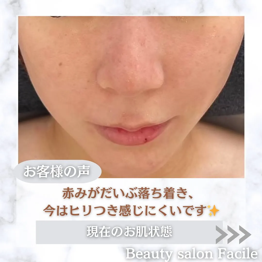 太田市にある頑固なニキビ専門店です✨️