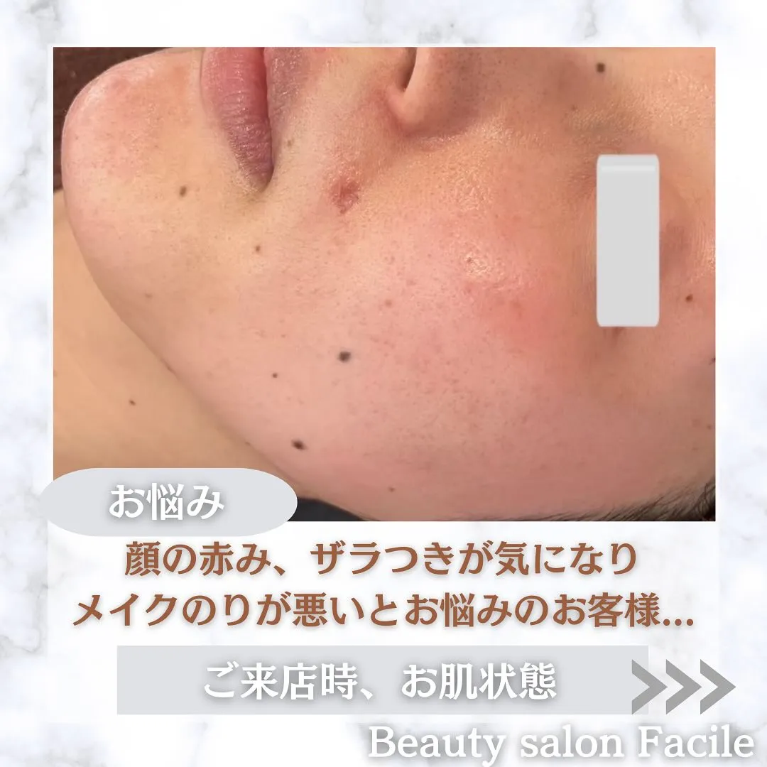 太田市にある頑固なニキビ専門店です✨️