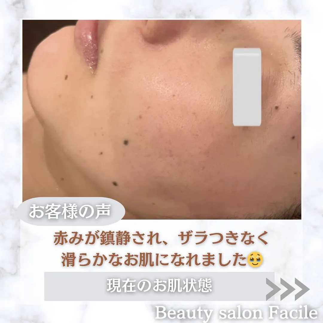 太田市にある頑固なニキビ専門店です✨️