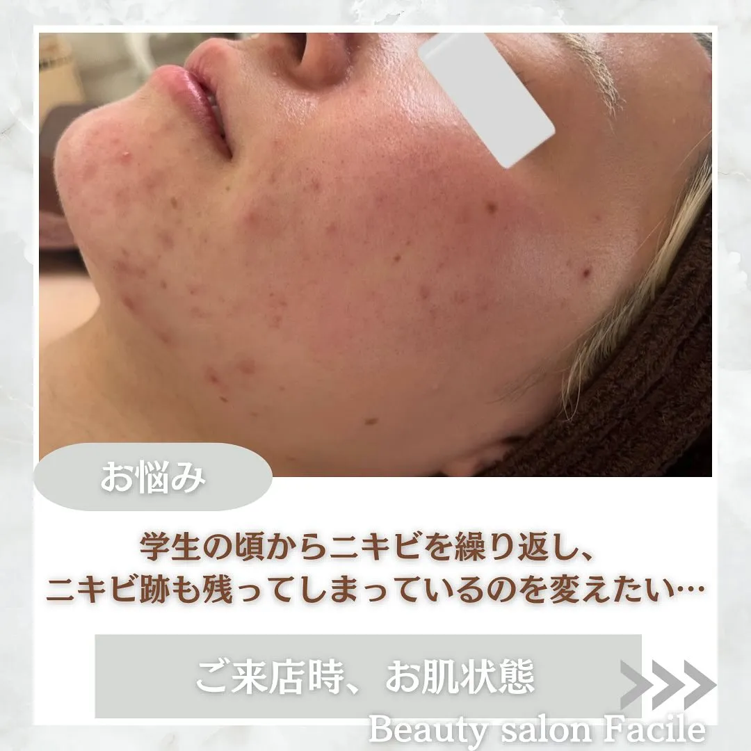 太田市にある頑固なニキビ専門店です✨️