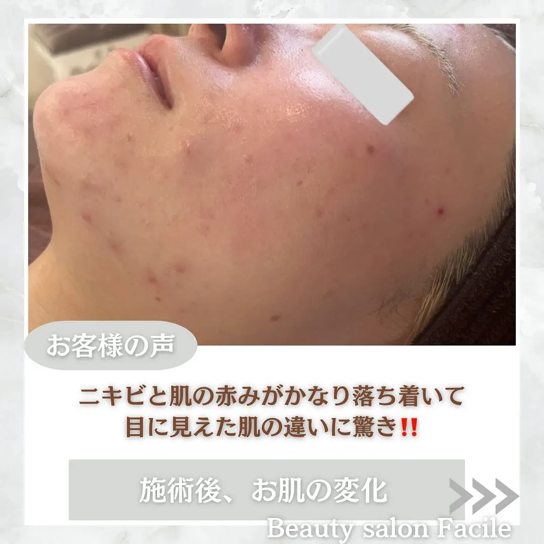 太田市にある頑固なニキビ専門店です✨️