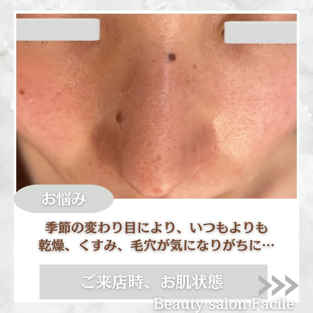 太田市にある頑固なニキビ専門店です✨️