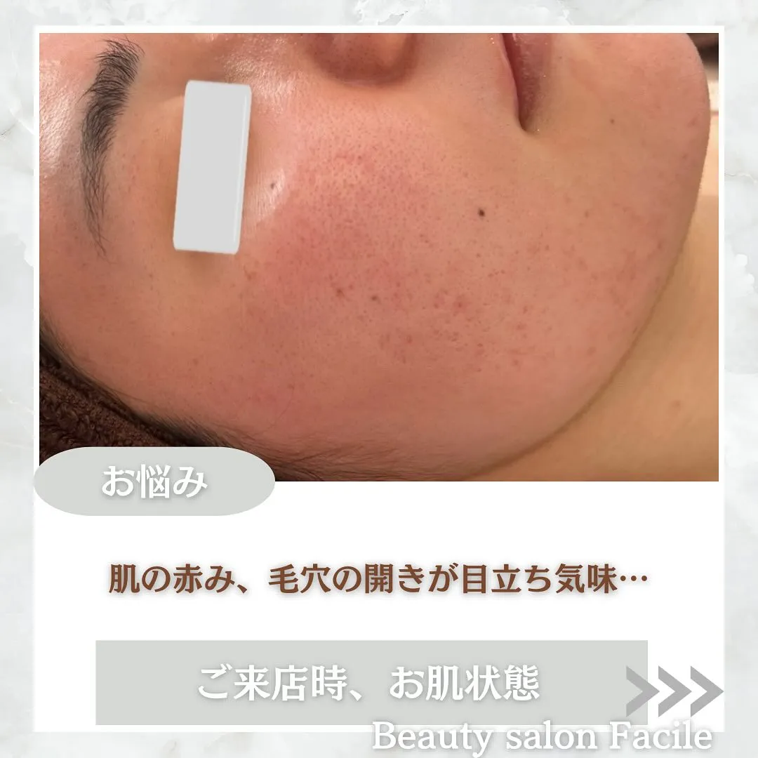 太田市にある頑固なニキビ専門店です✨️