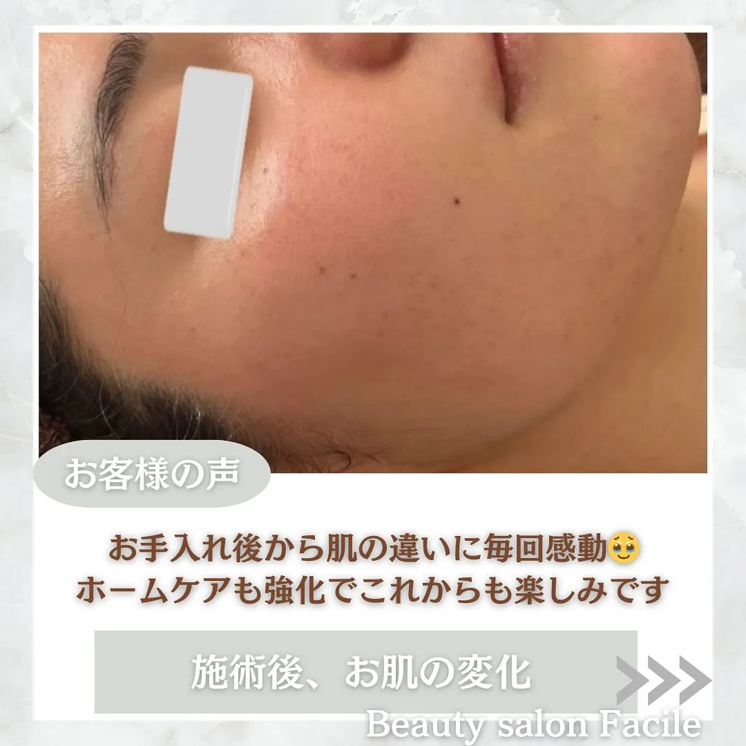 太田市にある頑固なニキビ専門店です✨️