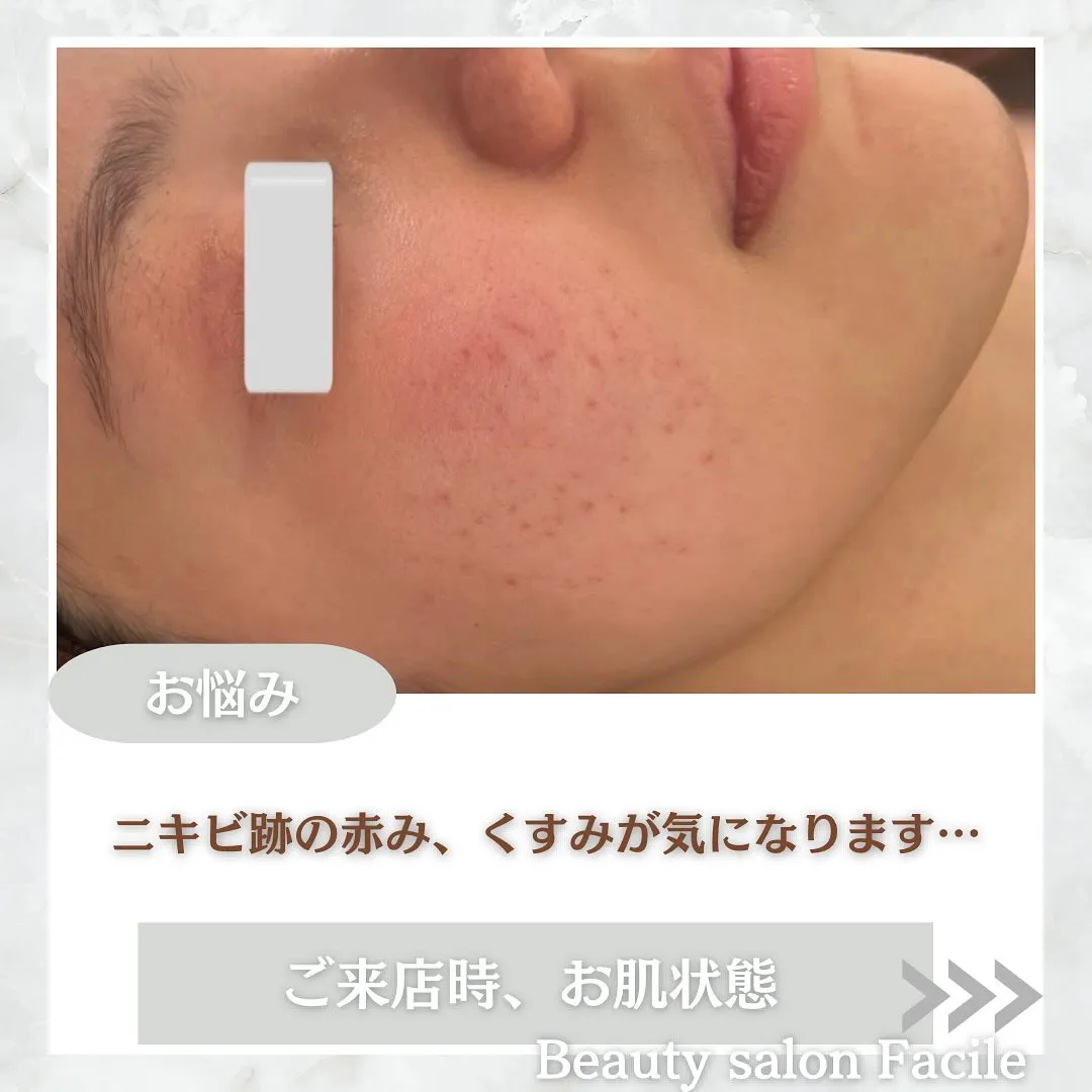 太田市にある頑固なニキビ専門店です✨️