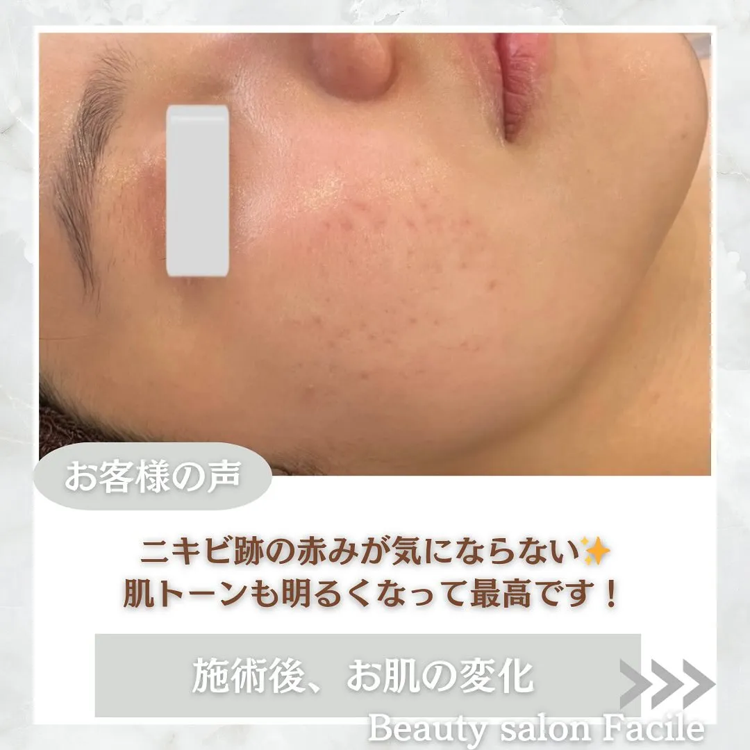 太田市にある頑固なニキビ専門店です✨️