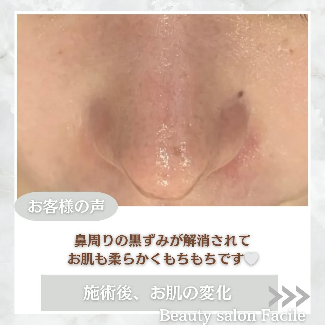 太田市にある頑固なニキビ専門店です✨️