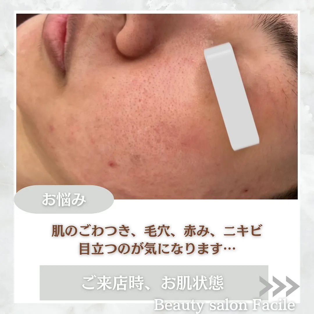 太田市にある頑固なニキビ専門店です✨️