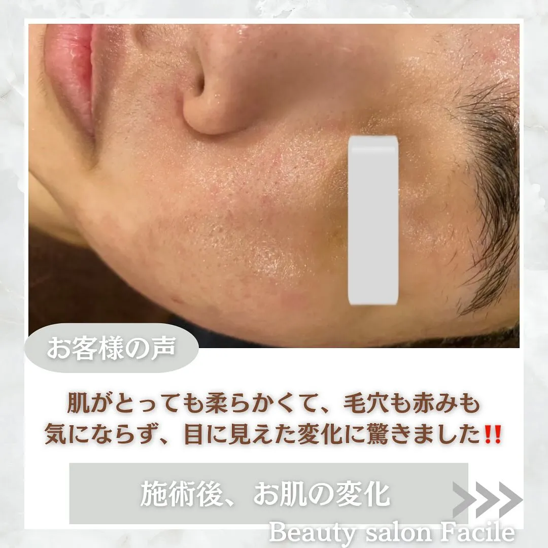 太田市にある頑固なニキビ専門店です✨️