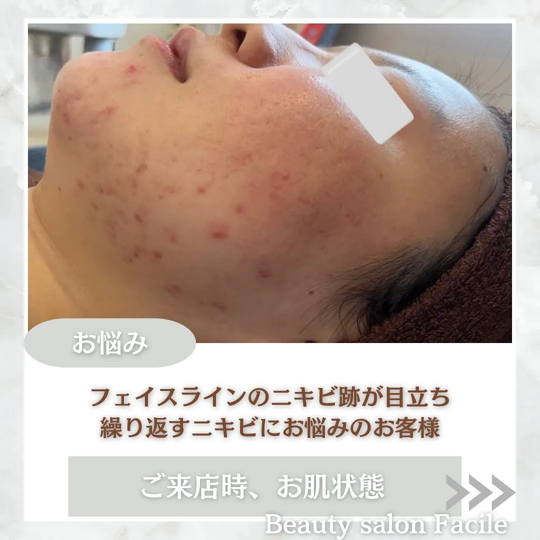 太田市にある頑固なニキビ専門店です✨️