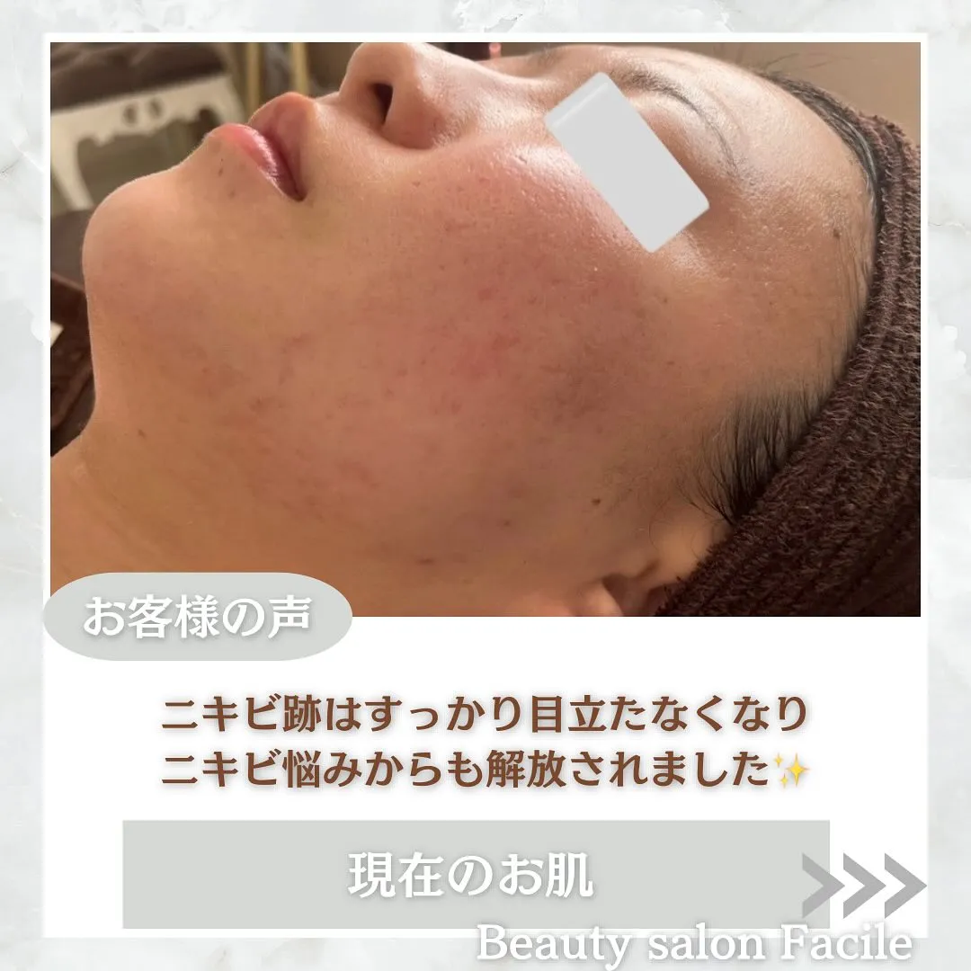 太田市にある頑固なニキビ専門店です✨️