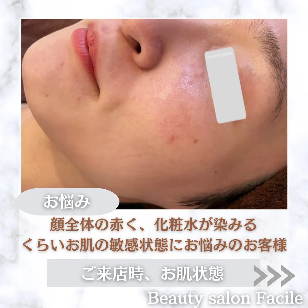 太田市にある頑固なニキビ専門店です✨️