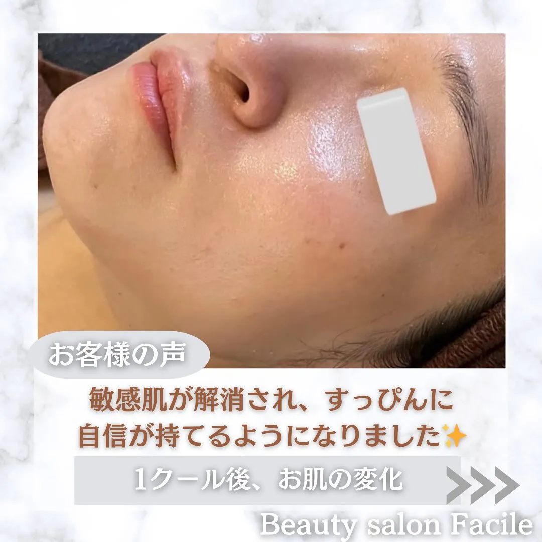 太田市にある頑固なニキビ専門店です✨️