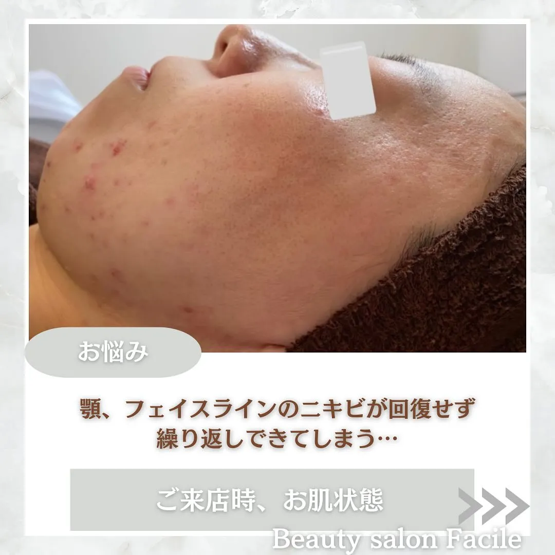 太田市にある頑固なニキビ専門店です✨️