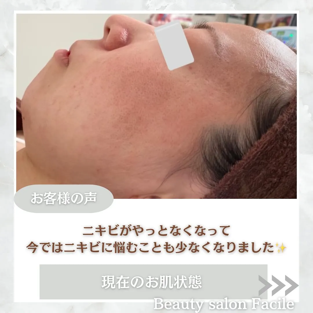 太田市にある頑固なニキビ専門店です✨️