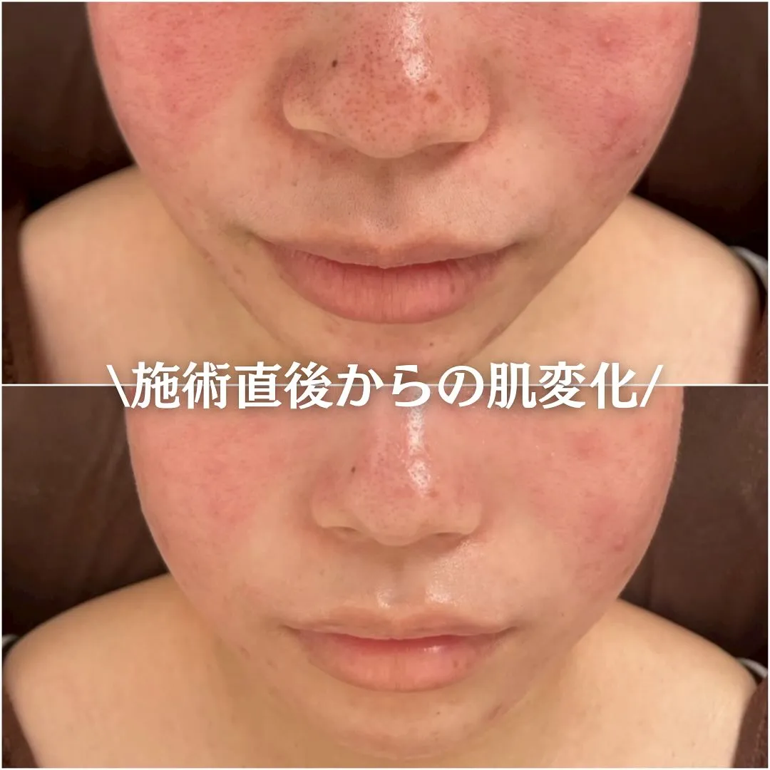 太田市にある頑固なニキビ専門店です✨️