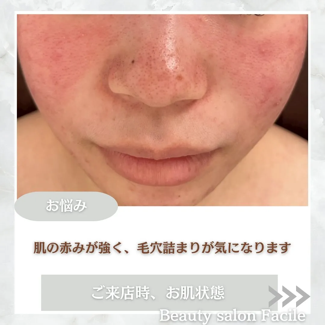 太田市にある頑固なニキビ専門店です✨️