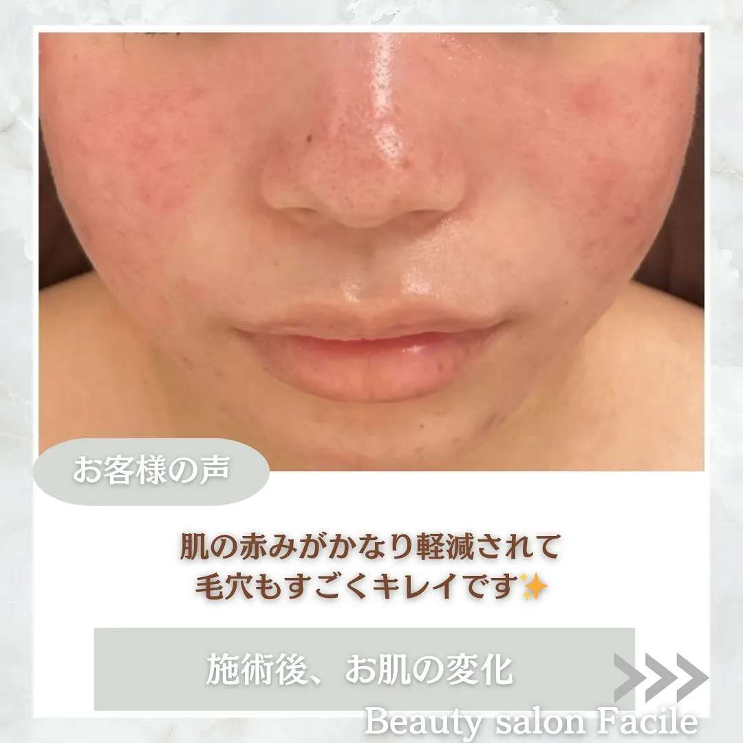 太田市にある頑固なニキビ専門店です✨️