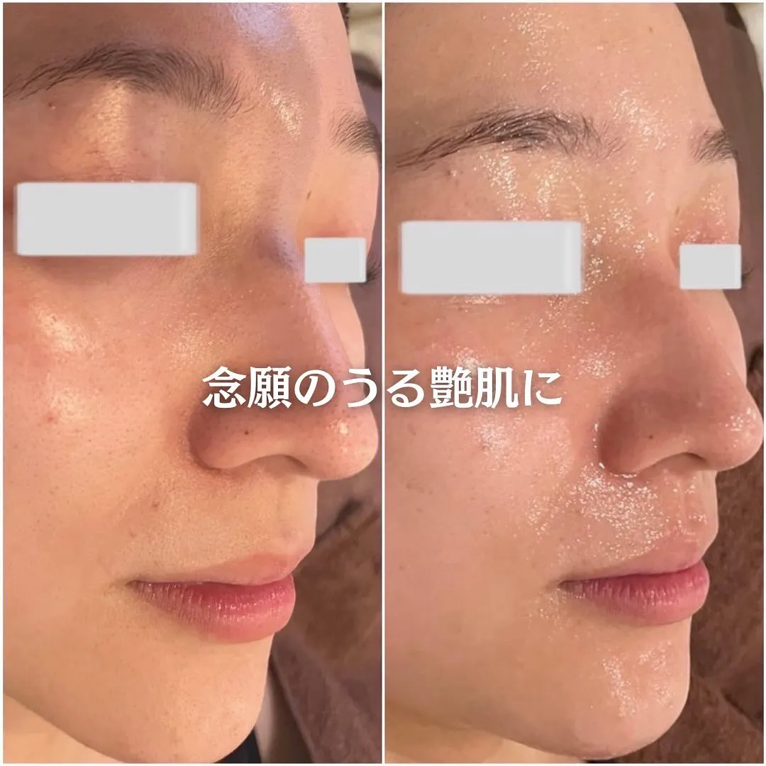 太田市にある頑固なニキビ専門店です✨️