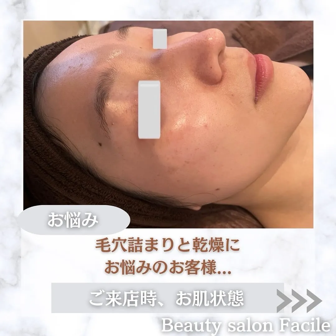 太田市にある頑固なニキビ専門店です✨️