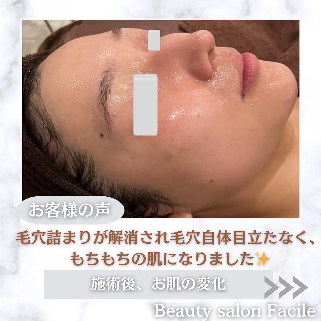 太田市にある頑固なニキビ専門店です✨️