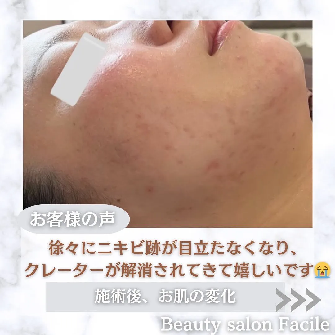 太田市にある頑固なニキビ専門店です✨️