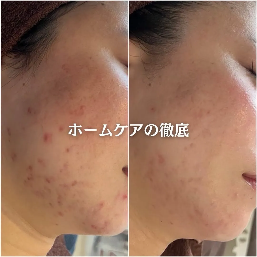 太田市にある頑固なニキビ専門店です✨️