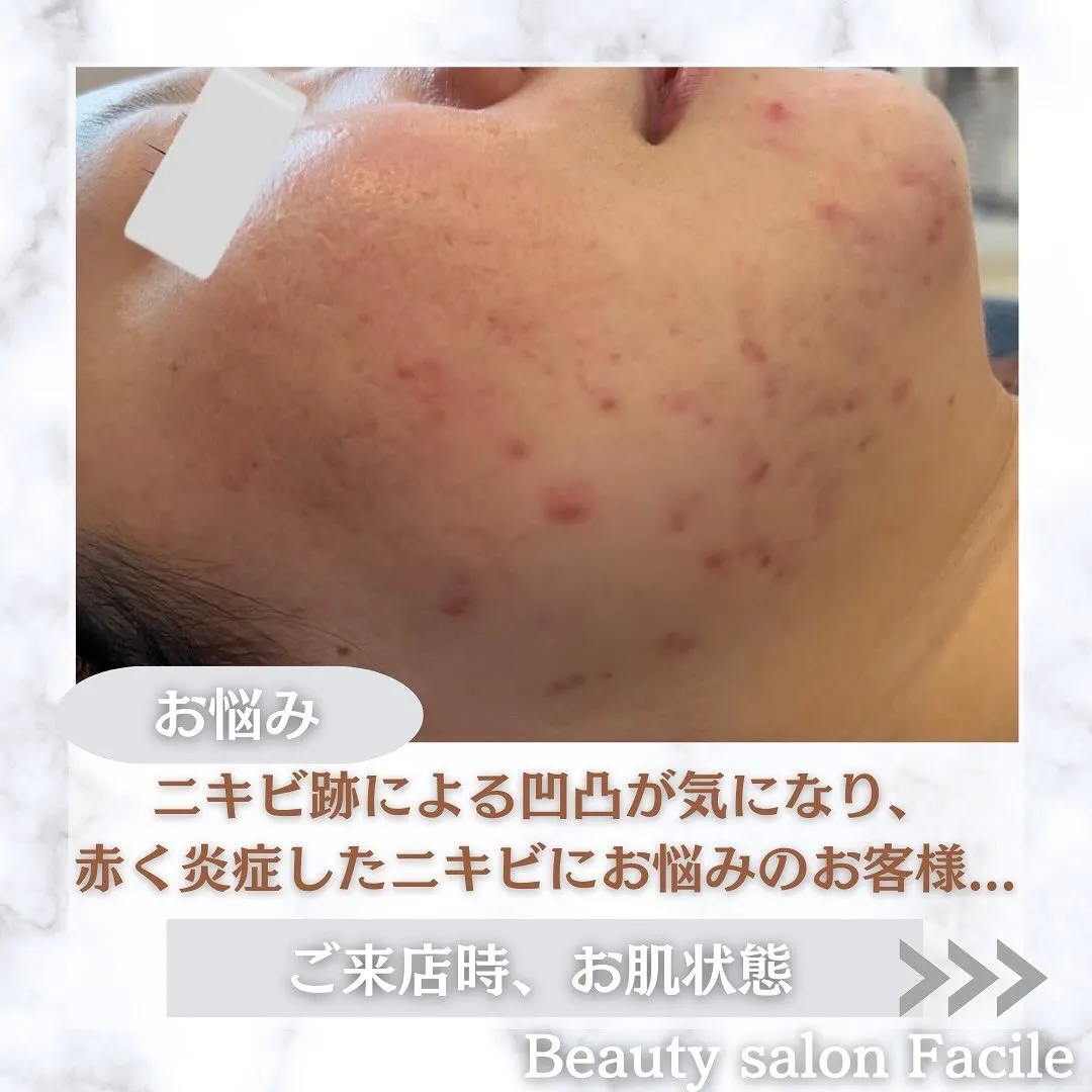 太田市にある頑固なニキビ専門店です✨️