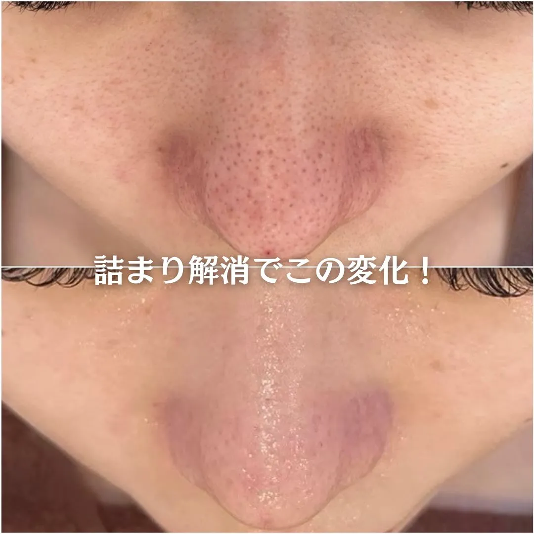 太田市にある頑固なニキビ専門店です✨️