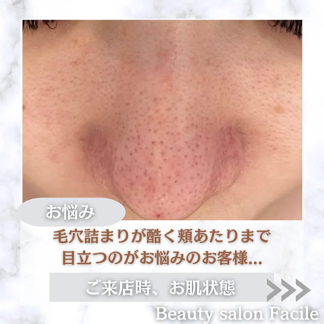 太田市にある頑固なニキビ専門店です✨️