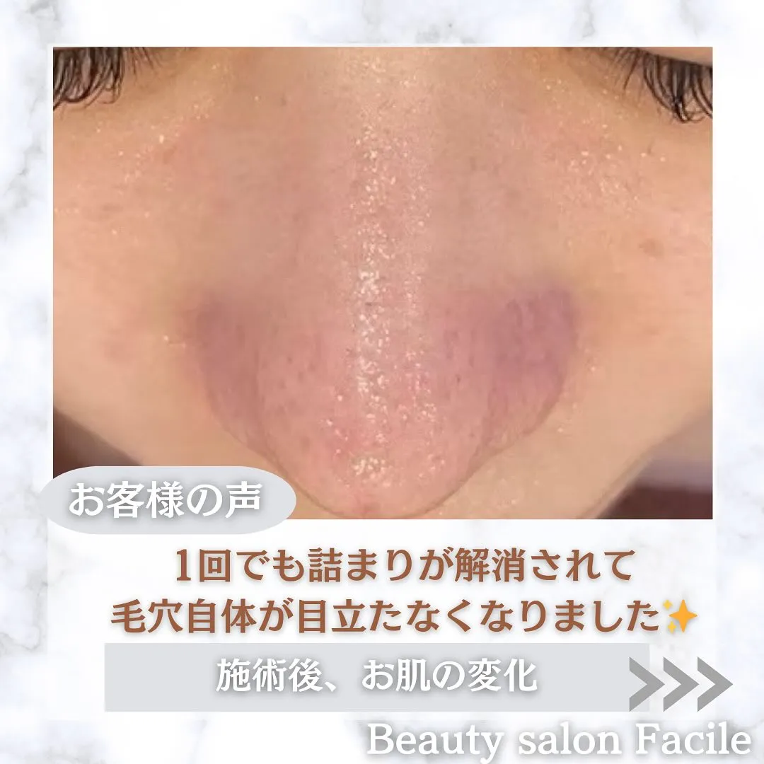 太田市にある頑固なニキビ専門店です✨️