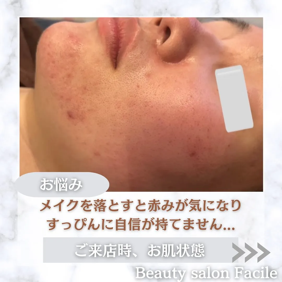 太田市にある頑固なニキビ専門店です✨️