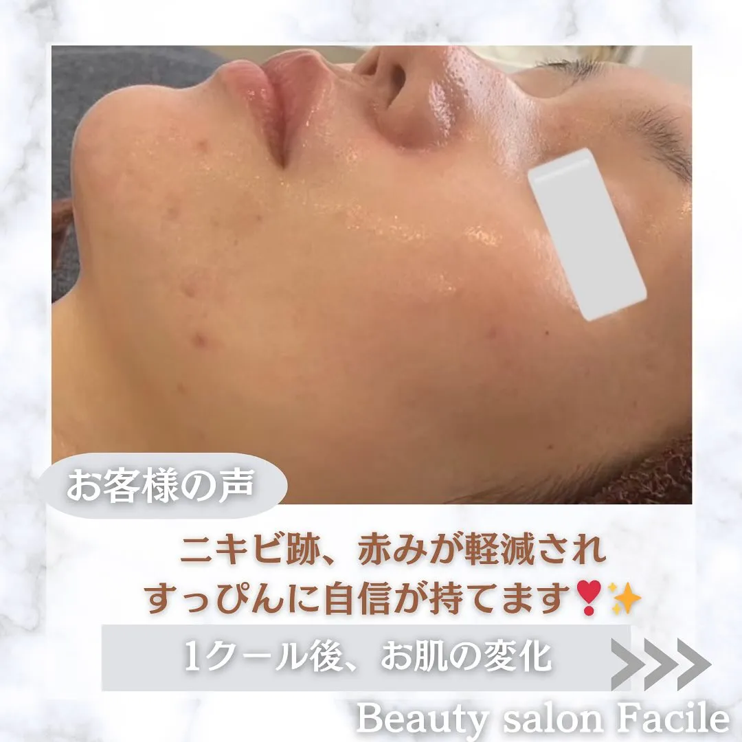 太田市にある頑固なニキビ専門店です✨️