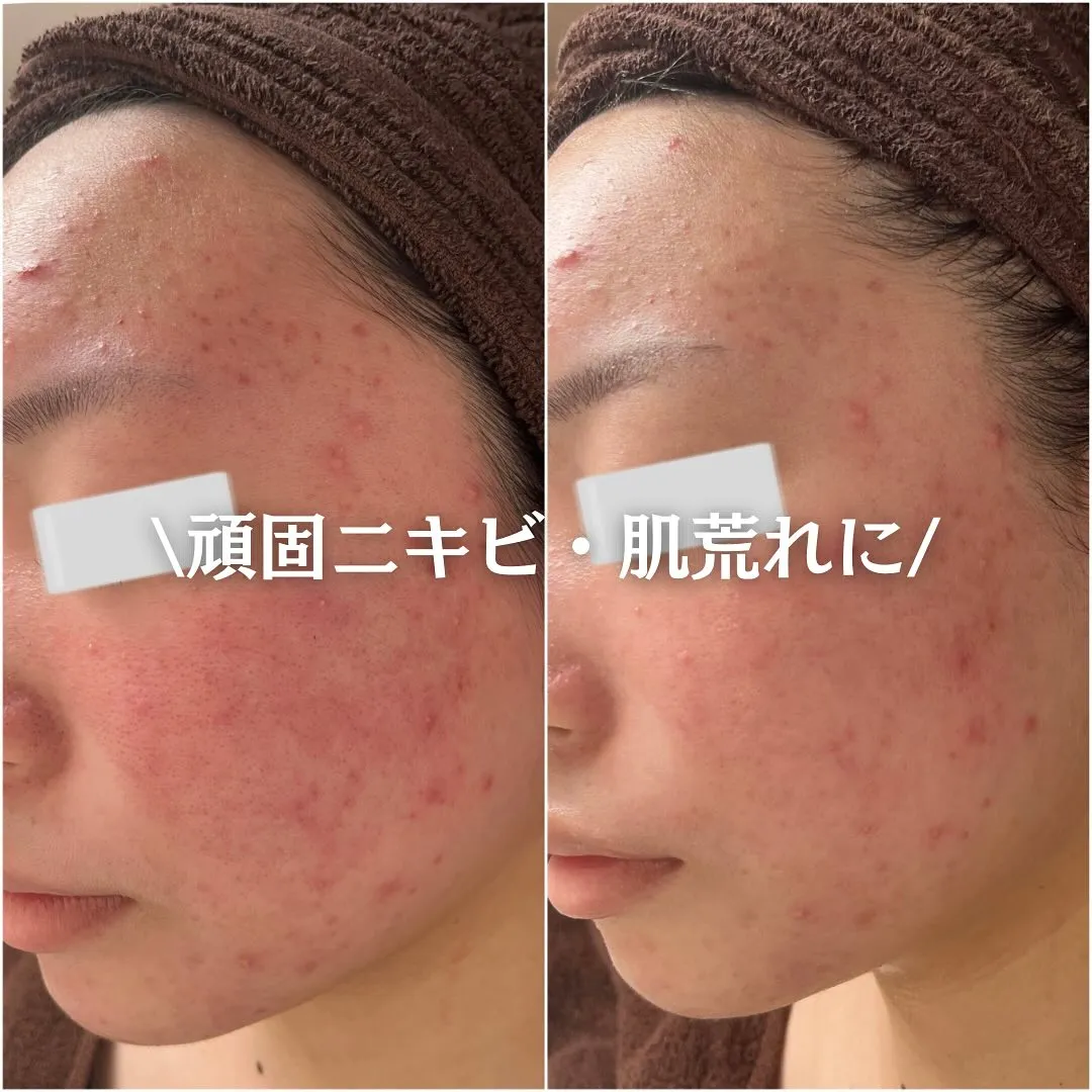 太田市にある頑固なニキビ専門店です✨️